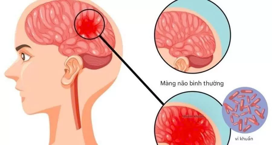 4 CA TỬ VONG DO NÃO MÔ CẦU, BỘ Y TẾ CẢNH BÁO DỊCH