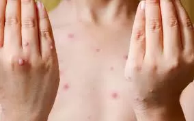 NHỮNG ĐIỀU CẦN BIẾT VỀ BỆNH THỦY ĐẬU