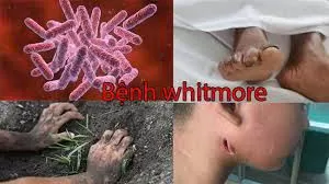 WHITEMORE – HIỂU ĐÚNG VỀ ‘VI KHUẨN ĂN THỊT NGƯỜI” ĐỂ CHỦ ĐỘNG PHÒNG BỆNH