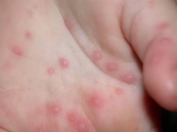 CHỦ ĐỘNG PHÒNG BỆNH TAY CHÂN MIỆNG – BẢO VỆ TRẺ TỪ NHỮNG HÀNH ĐỘNG ĐƠN GIẢN MỖI NGÀY